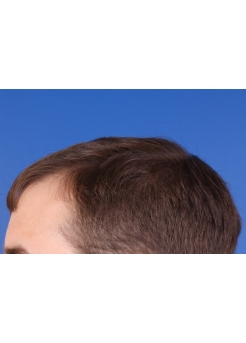Before Hair Transplant&nbsp;Hairlines